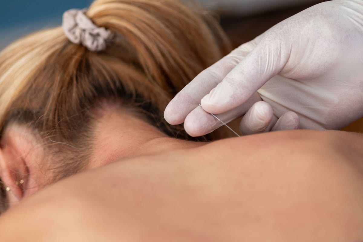 Acupuncture